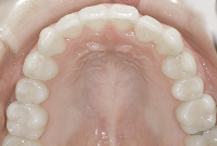 治療後上顎の歯並び画像