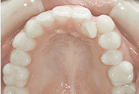 上顎の歯並び画像