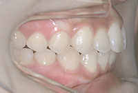 治療後の横からの歯並び画像