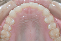 治療後の上顎の歯並び画像