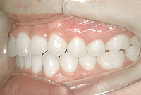 治療後の横からの歯並び画像