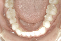 治療後の下顎の歯並び画像