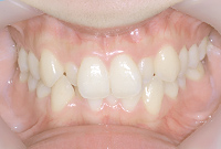 歯並びの正面画像