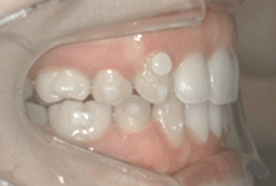 治療後の横から見た歯並び画像