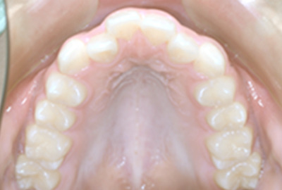 下顎の歯並び画像