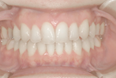 治療後の歯並びの正面画像
