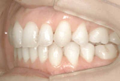 治療後の横から見た歯並び画像