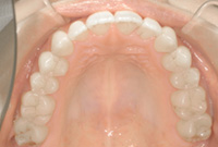 治療後の下顎の歯並び画像