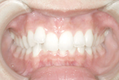 歯並びの正面画像