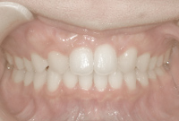 治療後の歯並びの正面画像
