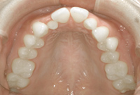 下顎の歯並び画像